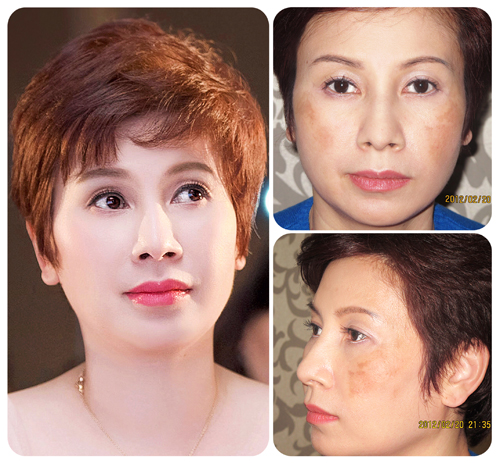 Nhìn làn da mướt mịn, sáng bừng như hiện tại, ít ai biết rằng chị Hằng từng stress nặng khi vết nám che khắp gương mặt