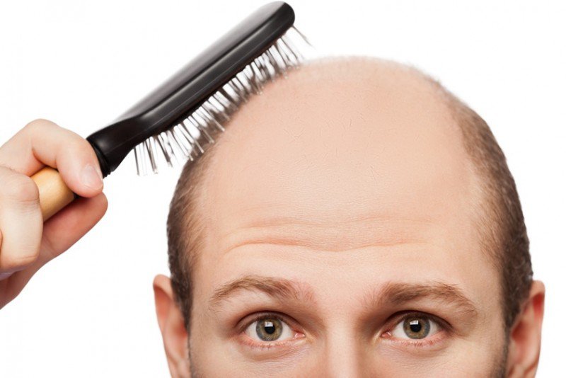 Những nguyên nhân gây rụng tóc ở nam giới