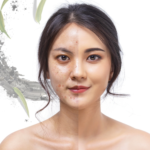 Trị mụn sinh học tinh chất tre