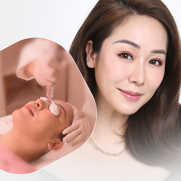 Laser trị nám/ tàn nhang